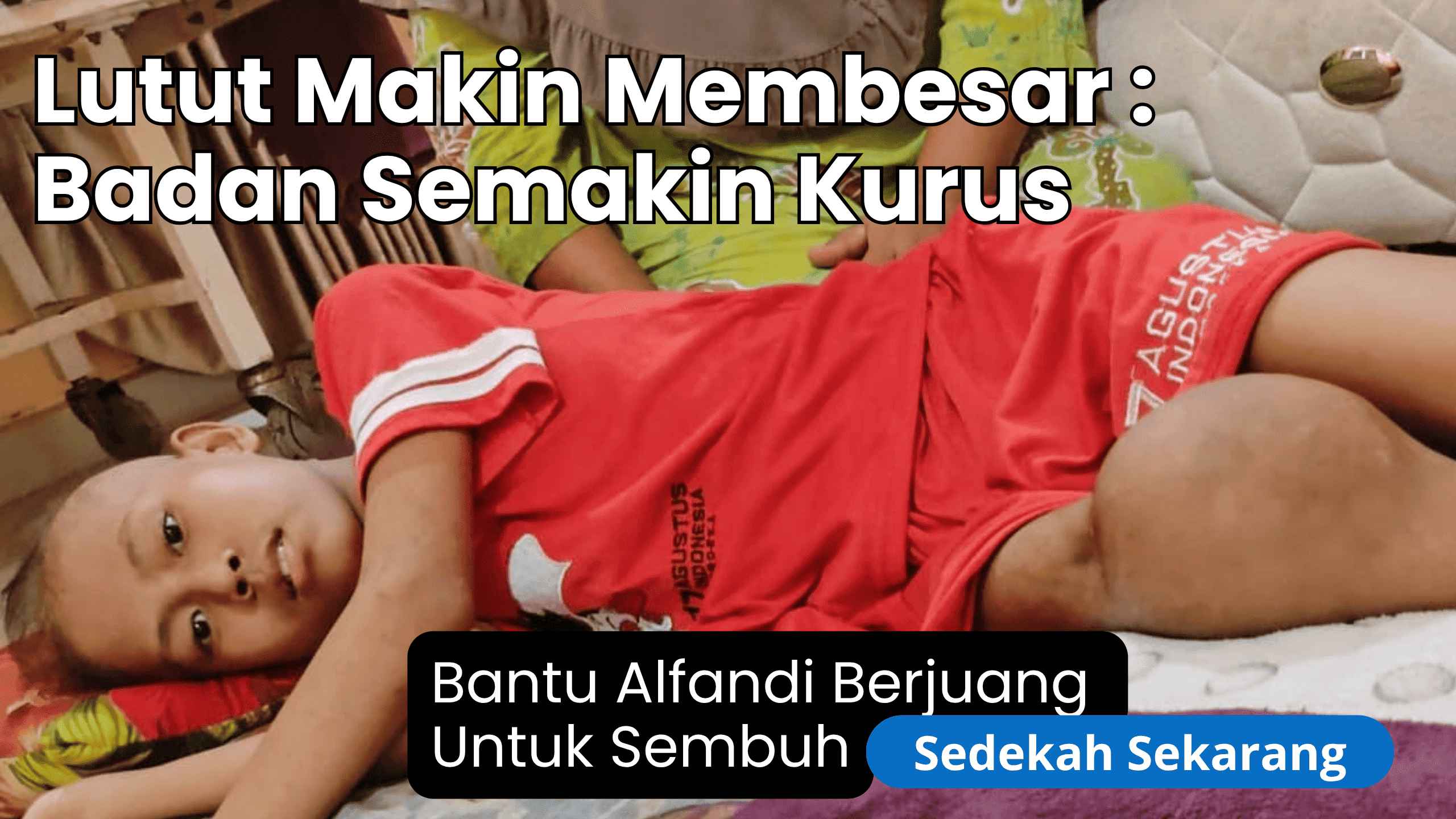 Tubuhnya semakin kurus di tengah kaki yang bengkak akibat kanker tulang yang menyerang Fandi